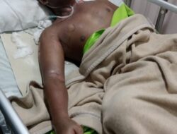 Luka Bakar 70 Persen, Nasrudin Warga Air Naningan Tanggamus Butuh Uluran Tangan